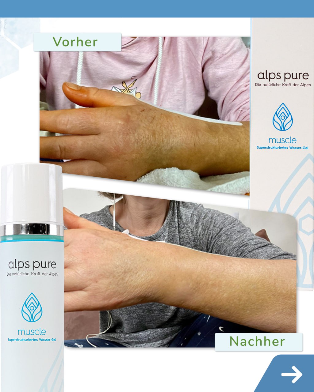 muscle – Vorher / Nachher Hand