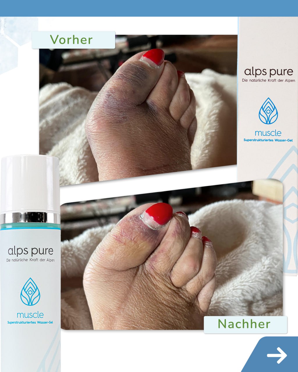 muscle – Vorher / Nachher Fuß